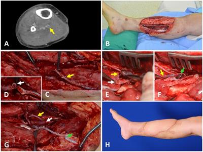 Deep vein thrombosis in donor or recipient veins encountered during lower extremity reconstruction with a free anterolateral thigh perforator flap: How do we deal with it?